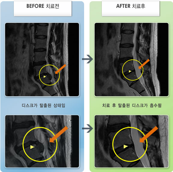 자생한방병원 치료사례 MRI로 보는 치료결과-허리디스크로 인한 허리 통증과 오른쪽 다리 저림 증상