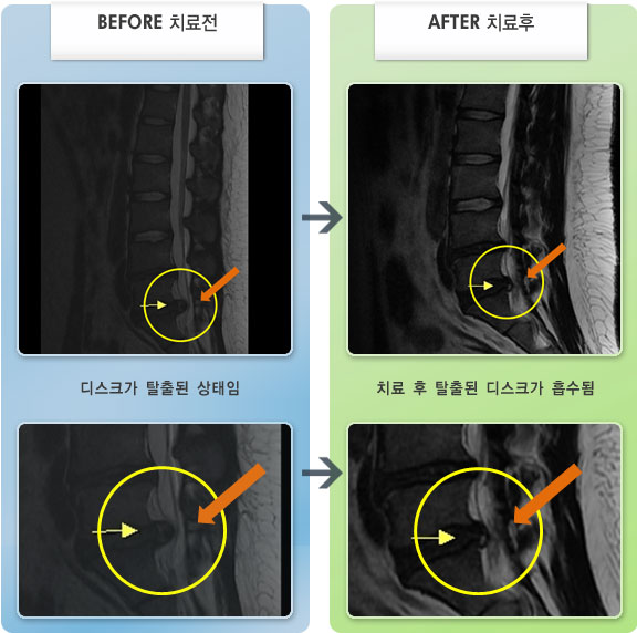 자생한방병원 치료사례 MRI로 보는 치료결과-좌측 허리 통증과 좌측 둔부에서 발끝 저림 증상