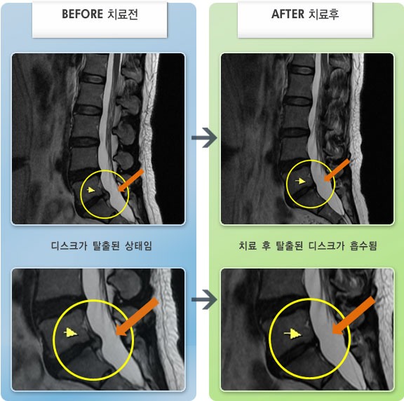자생한방병원 치료사례 MRI로 보는 치료결과-허리디스크로 인한 허리 통증 및 야간통