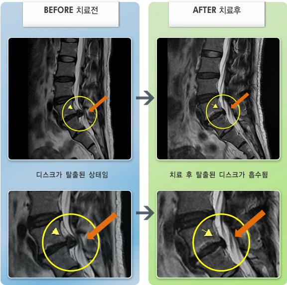 자생한방병원 치료사례 MRI로 보는 치료결과-허리 통증 및 왼쪽 다리 당김 증상