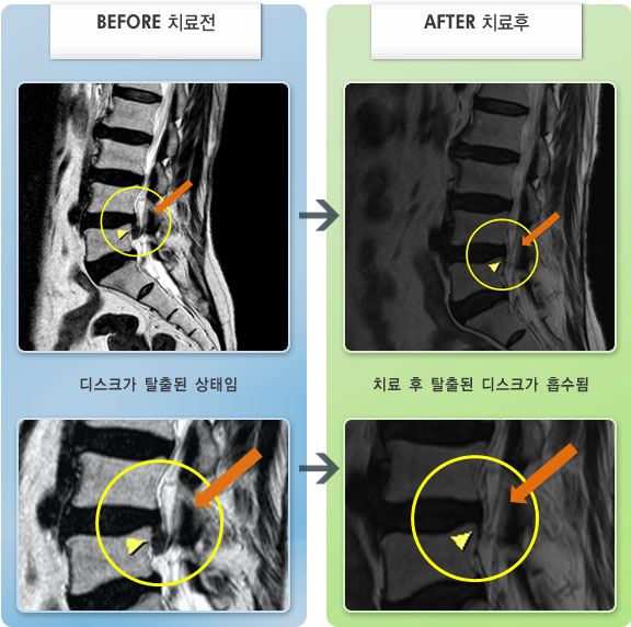 자생한방병원 치료사례 MRI로 보는 치료결과-허리디스크로 인한 우측 허리 엉덩이 통증