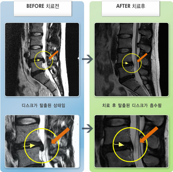 자생한방병원 치료사례 MRI로 보는 치료결과-허리디스크로 인한 허리 및 오른쪽 다리 당김 증상