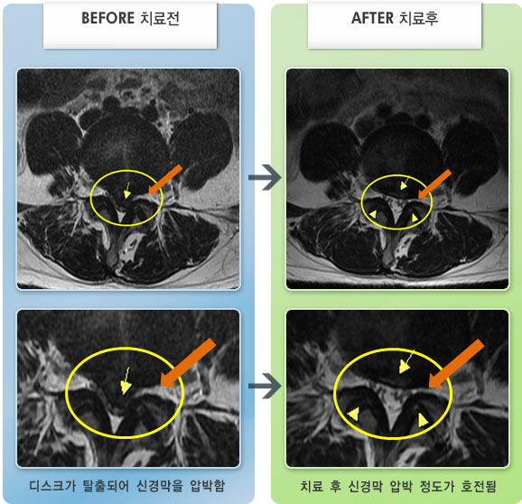 자생한방병원 치료사례 MRI로 보는 치료결과-허리와 왼쪽 다리 통증이 있었다. 