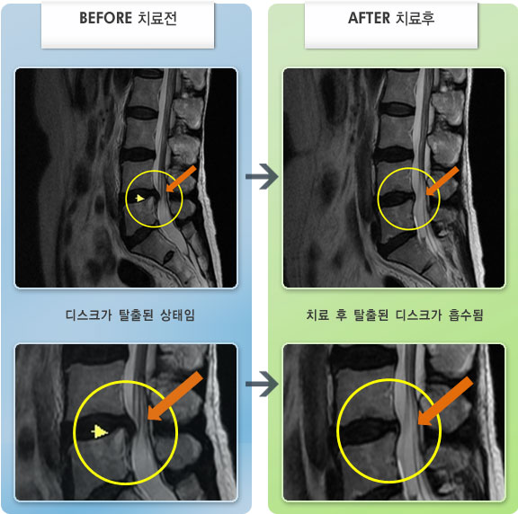 자생한방병원 치료사례 MRI로 보는 치료결과-허리 통증과 왼쪽 다리 저림 증상
