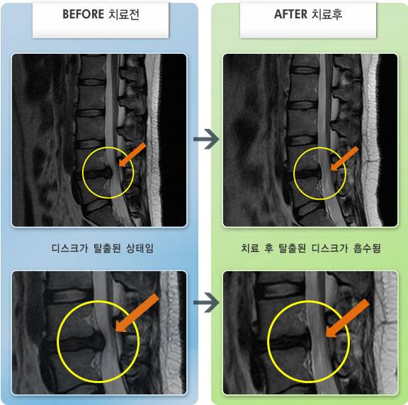 자생한방병원 치료사례 MRI로 보는 치료결과-허리디스크로 인한 허리 통증 및 우측 허벅지 당김 증상