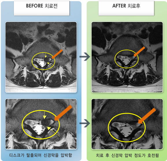 자생한방병원 치료사례 MRI로 보는 치료결과-허리 통증과 왼쪽 종아리 전기 통하는 느낌이 있었다.