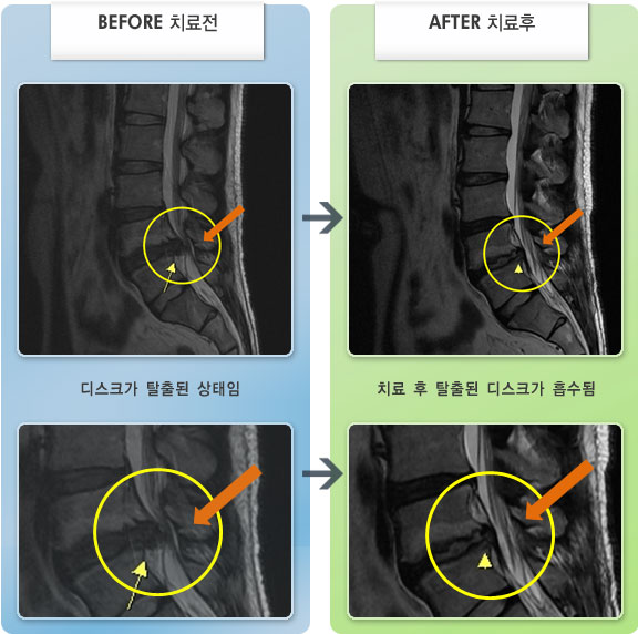 자생한방병원 치료사례 MRI로 보는 치료결과-오른쪽 엉치 및 발 뒤꿈치 통증