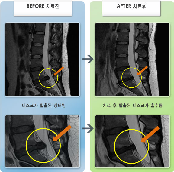 자생한방병원 치료사례 MRI로 보는 치료결과-허리디스크로 인한 허리 가운데 통증