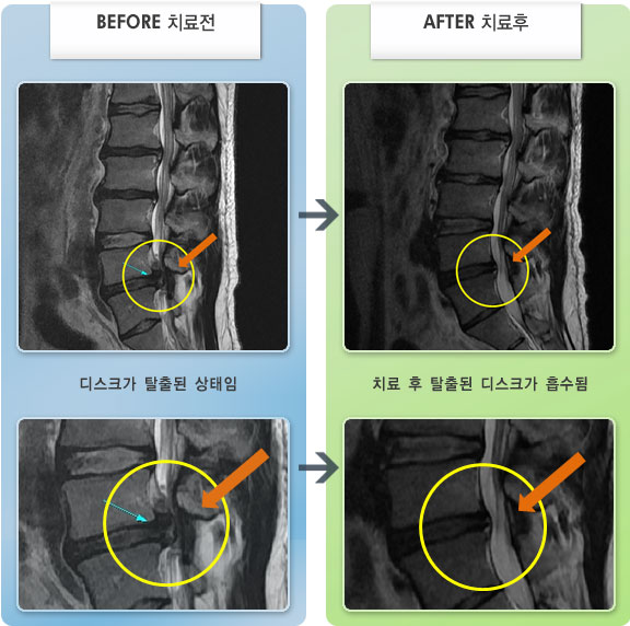 자생한방병원 치료사례 MRI로 보는 치료결과-양쪽 엉덩이 통증과 왼족 다리 저림 증상