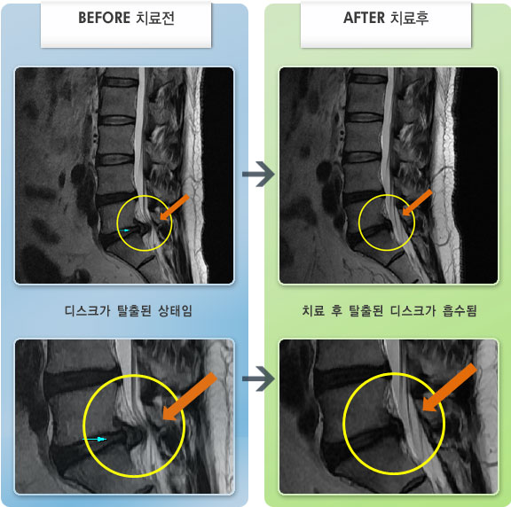 자생한방병원 치료사례 MRI로 보는 치료결과-허리와 양쪽 둔부 통증