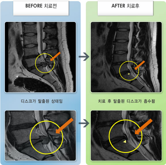자생한방병원 치료사례 MRI로 보는 치료결과-허리디스크로 인한 왼쪽 엉덩이 통증 및 허벅지 뒷쪽 저림 증상