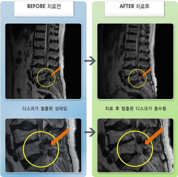 자생한방병원 치료사례 MRI로 보는 치료결과-왼쪽 엉치와 고관절 및 발목 통증