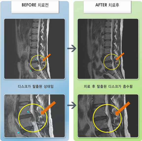 자생한방병원 치료사례 MRI로 보는 치료결과-오른쪽 허리 엉덩이에서 발까지 통증과 저림 당김 및 누르는 증상