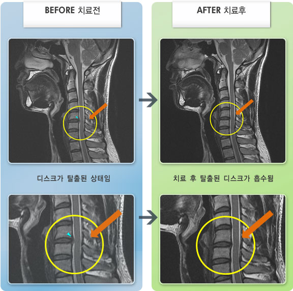 자생한방병원 치료사례 MRI로 보는 치료결과-목, 어깨 부위에 전반적으로 통증