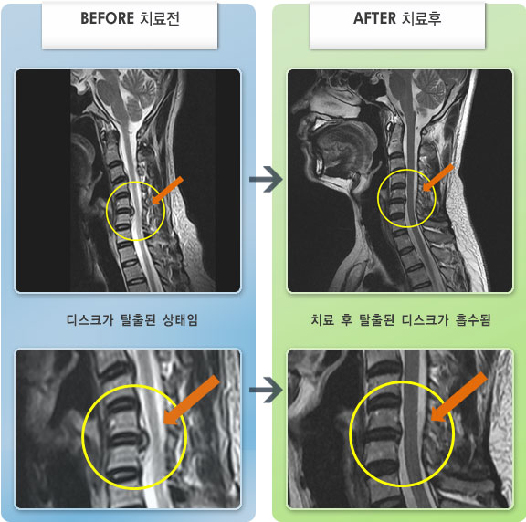 자생한방병원 치료사례 MRI로 보는 치료결과-목 통증과 왼쪽 팔에서 손가락까지 저림