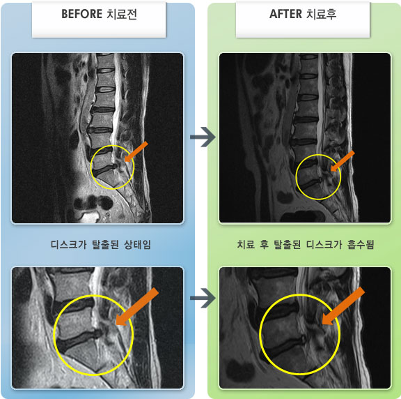 자생한방병원 치료사례 MRI로 보는 치료결과-허리 통증과 왼쪽 다리 저림이 있음