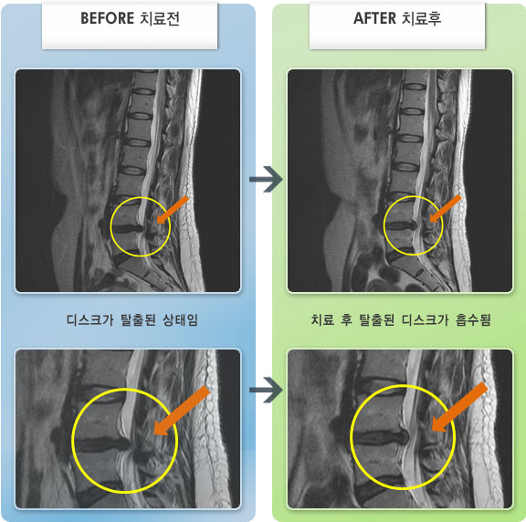자생한방병원 치료사례 MRI로 보는 치료결과-허리 통증과 오른쪽 고관절, 엉치 통증