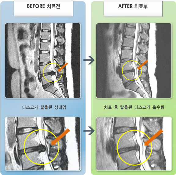 자생한방병원 치료사례 MRI로 보는 치료결과-허리와 왼쪽 다리 통증