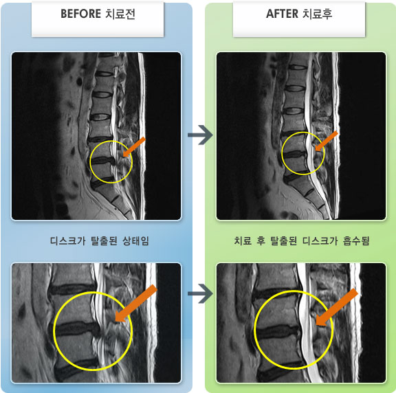 자생한방병원 치료사례 MRI로 보는 치료결과-허리에서 왼쪽 골반 통증과 엉치에서 종아리까지 통증