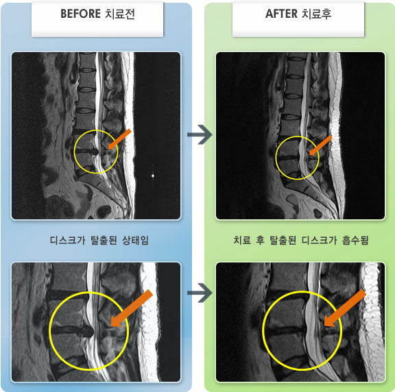 자생한방병원 치료사례 MRI로 보는 치료결과-서있을 때 누워있을 때 통증