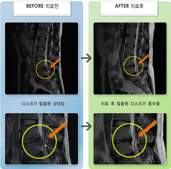 자생한방병원 치료사례 MRI로 보는 치료결과-왼쪽 엉덩이부터 다리 바깥쪽으로 발목까지 아프고 저림