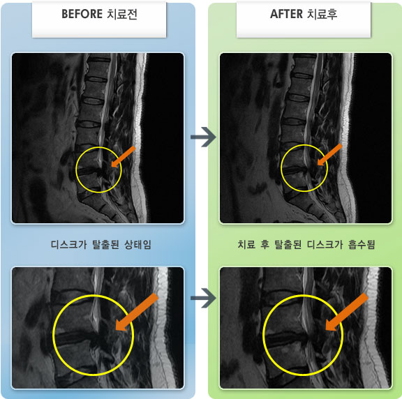 자생한방병원 치료사례 MRI로 보는 치료결과-아침에 일어나면 우측 종아리가 심하게 저림
