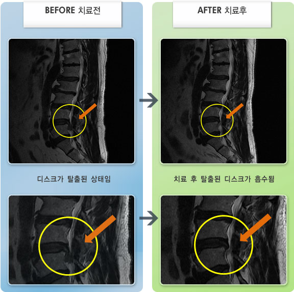 자생한방병원 치료사례 MRI로 보는 치료결과-허리 통증과 왼쪽 엉치, 허벅지에서 다리 저림 및 감각 둔함