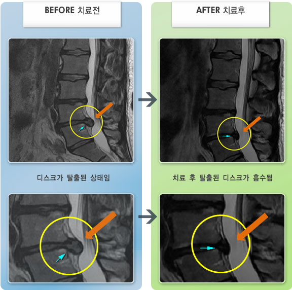 자생한방병원 치료사례 MRI로 보는 치료결과-허리와 양쪽 엉덩이 통증 및 좌측 둔부, 대퇴, 소퇴 후면부 통증 및 저림