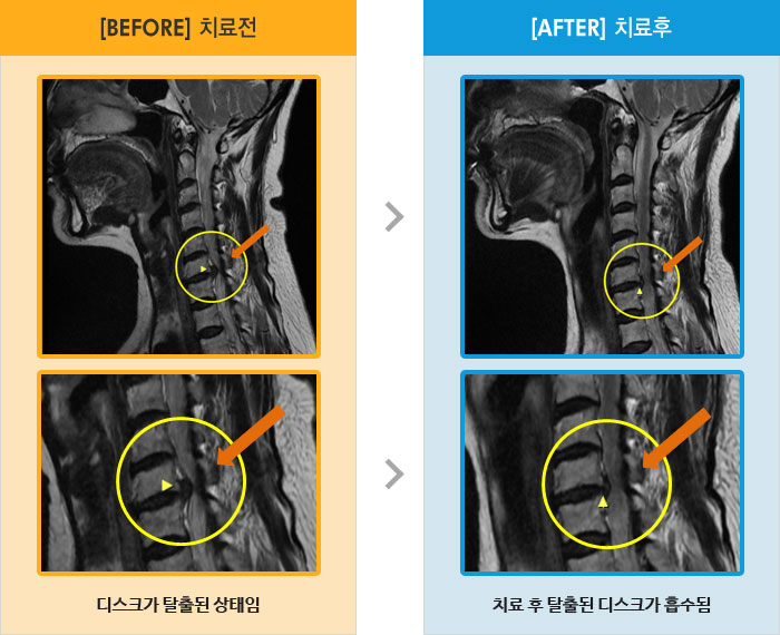 자생한방병원 치료사례 MRI로 보는 치료결과-심한 통증과 전기에 감전된 듯한 저림이 있음