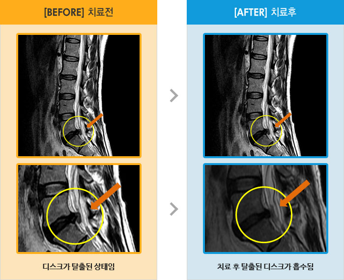 자생한방병원 치료사례 MRI로 보는 치료결과-오른쪽 엉덩이에서 발바닥까지 통증