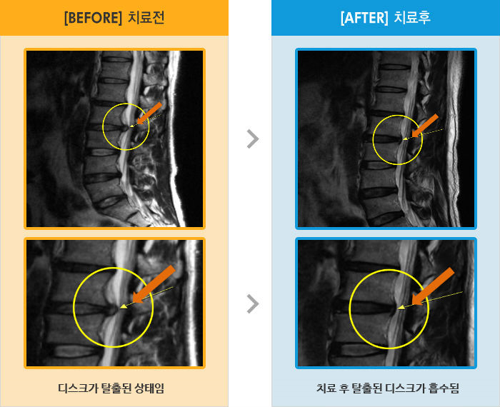 자생한방병원 치료사례 MRI로 보는 치료결과-왼쪽 허리가  바위를 눌려놓은 듯한 느낌