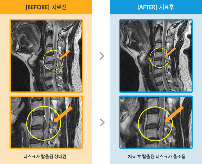 자생한방병원 치료사례 MRI로 보는 치료결과-지속적으로 오른쪽 목, 어깨 통증과 가끔 오른쪽 팔 저림 증상