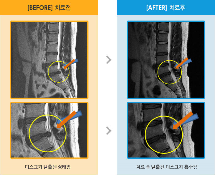 자생한방병원 치료사례 MRI로 보는 치료결과-허리와 왼쪽 엉덩이 통증 및 다리 저림