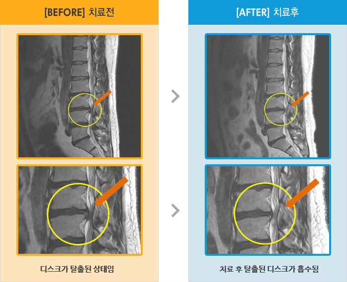 자생한방병원 치료사례 MRI로 보는 치료결과-허리 통증과 왼쪽 다리 감각이상 증상