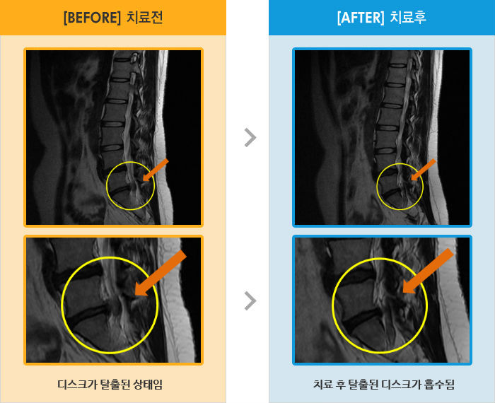 자생한방병원 치료사례 MRI로 보는 치료결과-왼쪽 허리와 다리가 심하게 저리고 쑤심