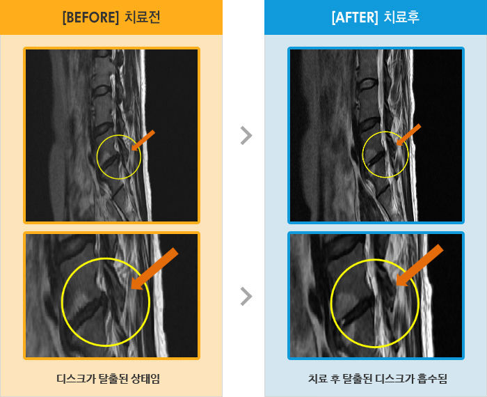 자생한방병원 치료사례 MRI로 보는 치료결과-허리 통증과 오른쪽 다리 발끝까지 저림