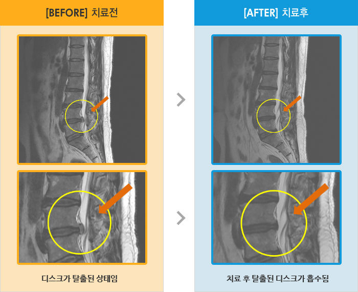 자생한방병원 치료사례 MRI로 보는 치료결과-허리와 왼쪽 다리 전체 통증 및 발목에서 발 저림