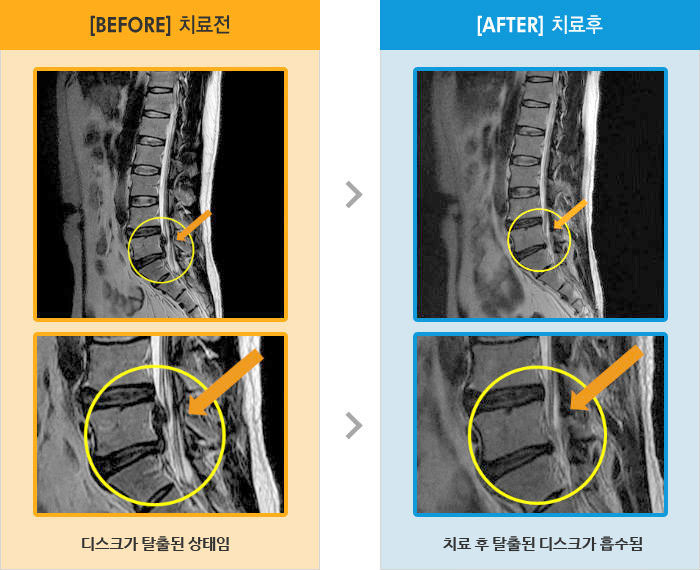 자생한방병원 치료사례 MRI로 보는 치료결과-왼쪽 종아리 당기는 느낌있고 엄지발가락 바닥쪽으로 둔한 느낌