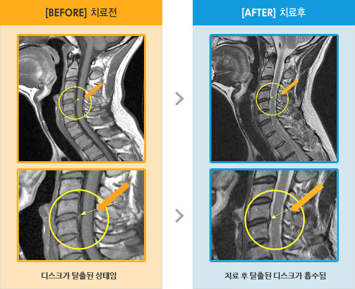 자생한방병원 치료사례 MRI로 보는 치료결과-목과 양쪽 어깨 통증