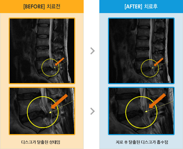자생한방병원 치료사례 MRI로 보는 치료결과-왼쪽 엉치부터 발목까지 저림 및 당김이 있고 근력 저하 증상