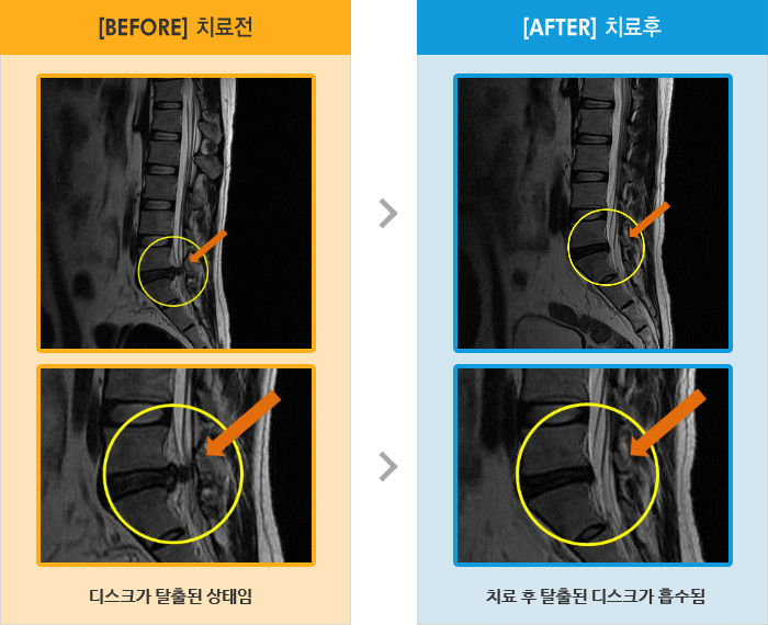 자생한방병원 치료사례 MRI로 보는 치료결과-허리와 왼쪽 엉치에서 종아리까지 통증