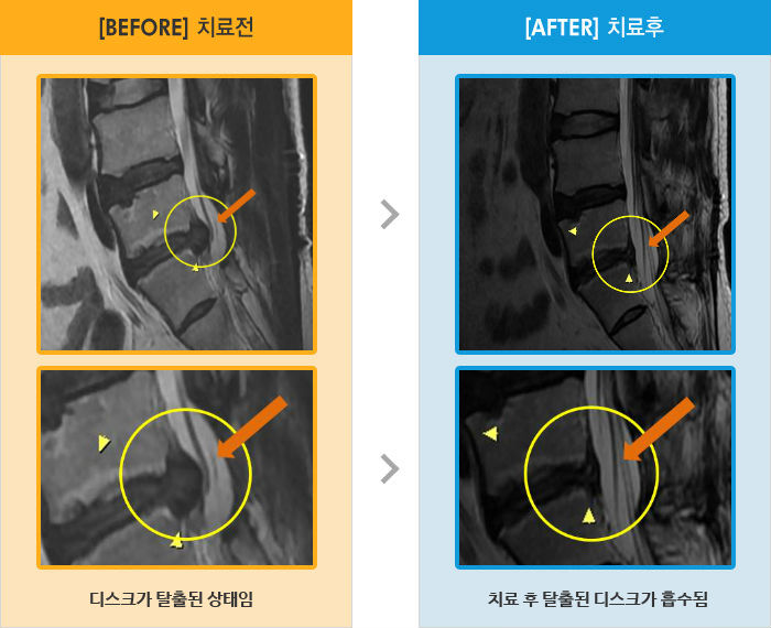자생한방병원 치료사례 MRI로 보는 치료결과-왼쪽 종아리 뒤와 발목이 많이 저림