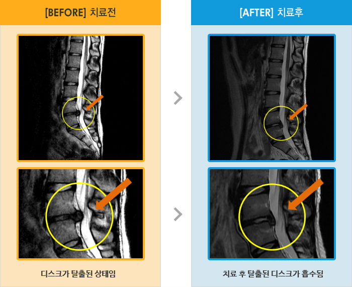 자생한방병원 치료사례 MRI로 보는 치료결과-오른쪽 엉치 통증 및 오른쪽 다리 저림으로 장시간 보행이 어려움
