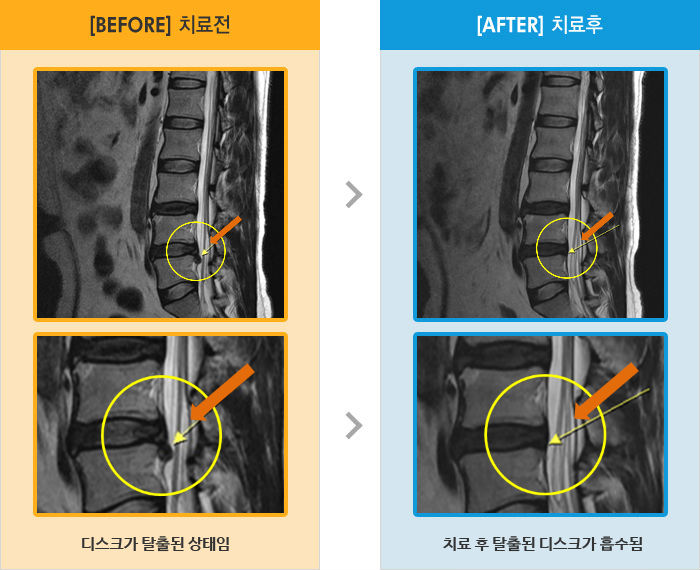 자생한방병원 치료사례 MRI로 보는 치료결과-어떤 자세에도 통증이 심함.