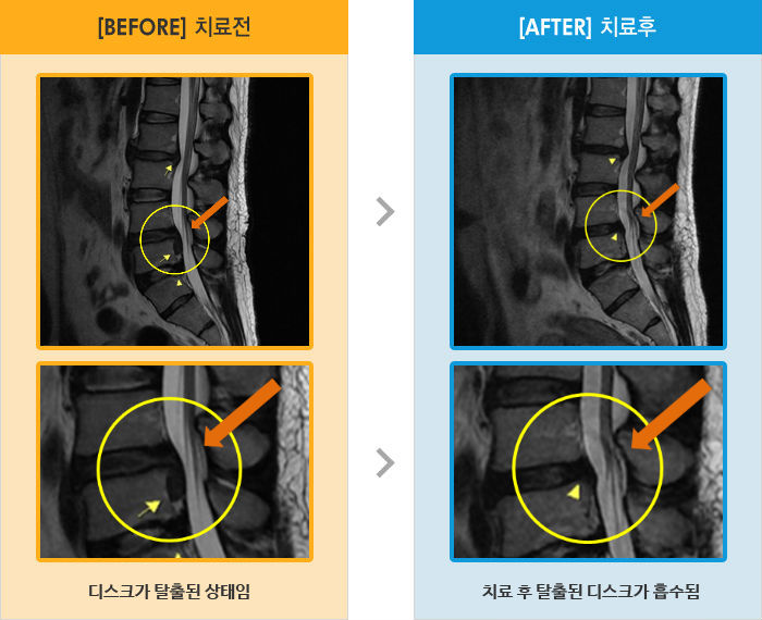 자생한방병원 치료사례 MRI로 보는 치료결과-허리와 오른쪽 엉덩이에서 다리 통증이 있었고 좌위 및 보행시 통증