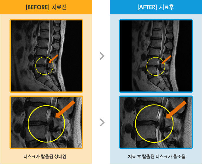 자생한방병원 치료사례 MRI로 보는 치료결과-왼쪽 엉치 통증이 있고 장시간 좌위시 통증이 증가