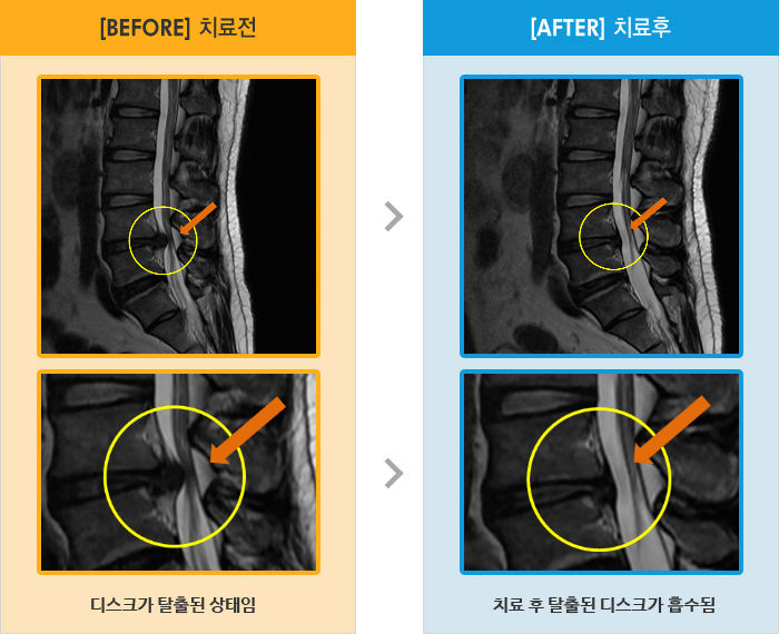 자생한방병원 치료사례 MRI로 보는 치료결과-허리 통증과 걸을 때 좌측 둔부의 통증