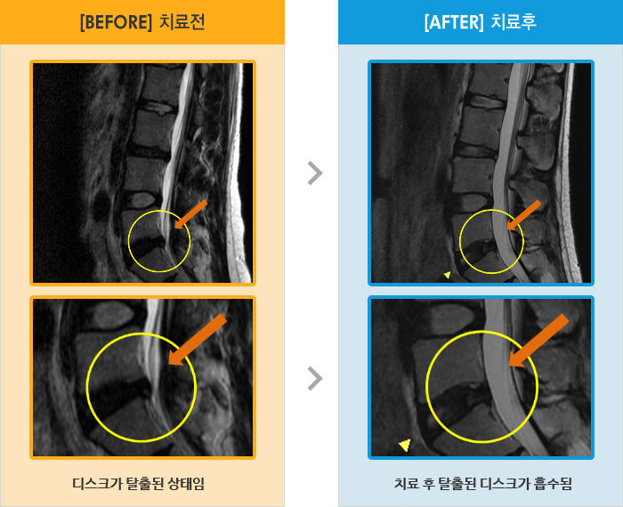 자생한방병원 치료사례 MRI로 보는 치료결과-허리와 오른쪽 다리 통증