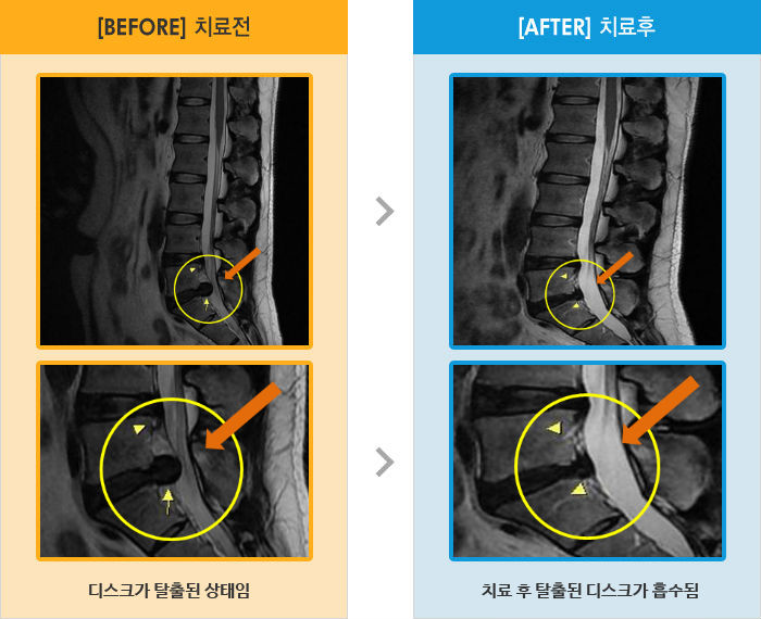자생한방병원 치료사례 MRI로 보는 치료결과-허리 통증과 오른쪽 엉치에서 종아리 당김과 저림