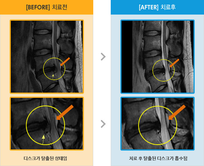 자생한방병원 치료사례 MRI로 보는 치료결과-앉거나 누워있다 일어날때 허리 통증
